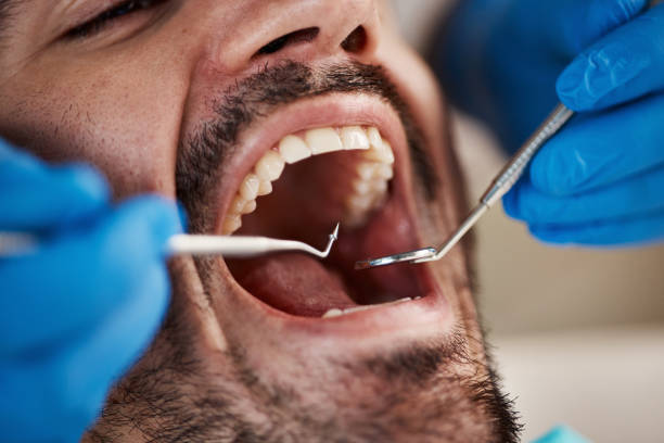 Best Emergency Tooth Extraction in Springfield, SD